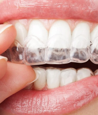 Капы для зубов в стоматологии