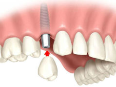 Нюансы имплантации на верхней челюсти
