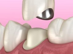 Протезирование коронками: эффективный способ восстановить утерянный зуб