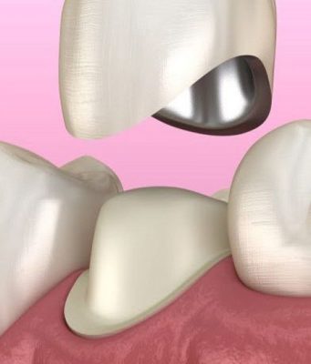 Протезирование коронками: эффективный способ восстановить утерянный зуб