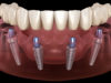 Как происходит имплантация All-on-4: полное протезирование зубов за 1 день