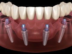 Как происходит имплантация All-on-4: полное протезирование зубов за 1 день