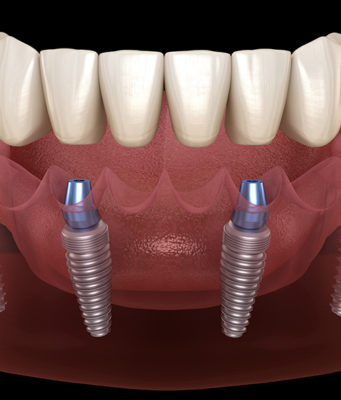 Как происходит имплантация All-on-4: полное протезирование зубов за 1 день