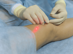 Что такое лазерная коагуляция вен