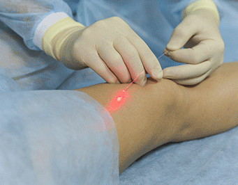 Что такое лазерная коагуляция вен