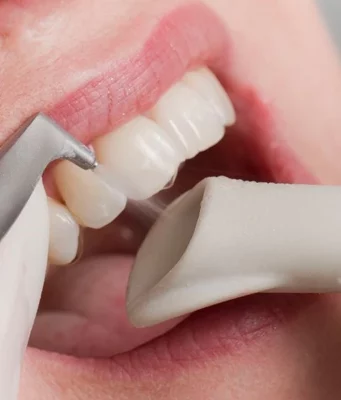 Что за услуга в стоматологии Air Flow?