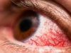 Красные глаза: причины и лечение