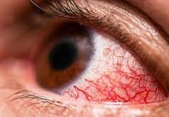 Красные глаза: причины и лечение