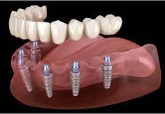 Протезирование зубов: восстановление улыбки и здоровья