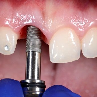 Имплантация зубов: восстановление утраченной улыбки