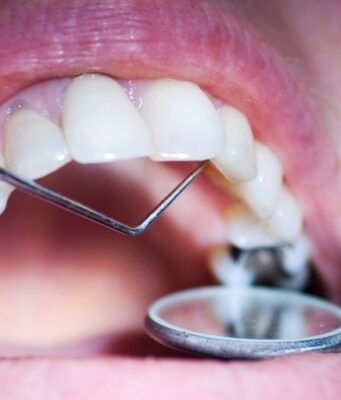 Лечение кариеса: современные методы и процедуры