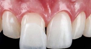 Виниры: как улыбка меняет жизнь — всё, что нужно знать о тонких пластинках счастья