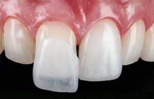 Виниры: как улыбка меняет жизнь — всё, что нужно знать о тонких пластинках счастья