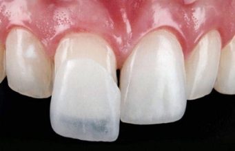 Виниры: как улыбка меняет жизнь — всё, что нужно знать о тонких пластинках счастья