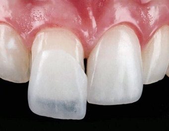 Виниры: как улыбка меняет жизнь — всё, что нужно знать о тонких пластинках счастья