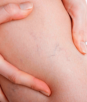 Когда пора к флебологу: 7 главных симптомов варикоза