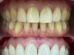 Белоснежная улыбка без паники: как отбелить зубы и сохранить здоровье