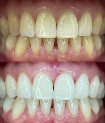 Белоснежная улыбка без паники: как отбелить зубы и сохранить здоровье