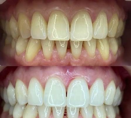 Белоснежная улыбка без паники: как отбелить зубы и сохранить здоровье